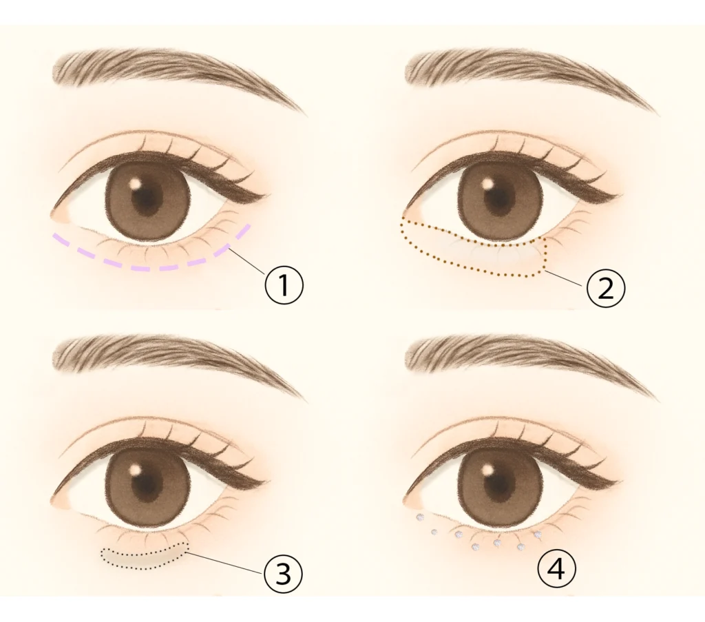 リキッドグリッターとコンシーラーを使った涙袋メイクの説明イラスト