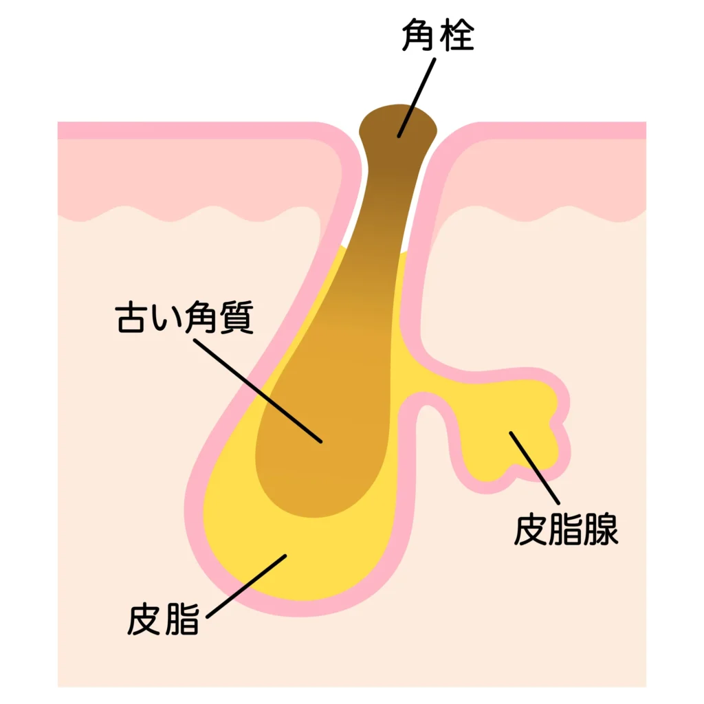 角栓のイメージ